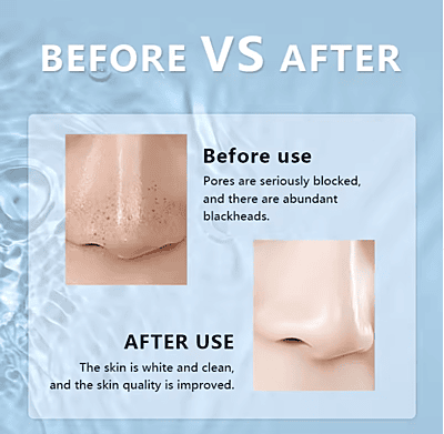 Electric Vacuum Blackhead Remover